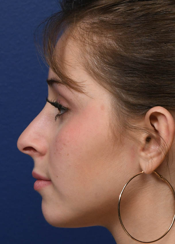 1_0019_Rhinoplasty 34 Postop 6 months.jpg