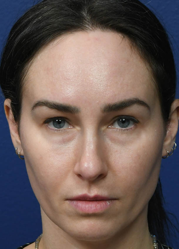 1_0020_Rhinoplasty 35 Frontal Preop.jpg