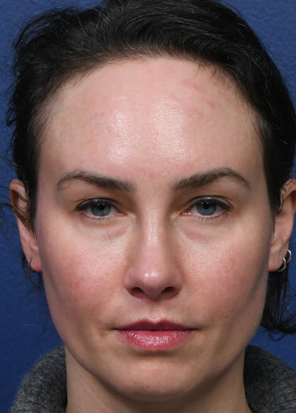 1_0021_Rhinoplasty 35 Frontal Postop 7 months.jpg