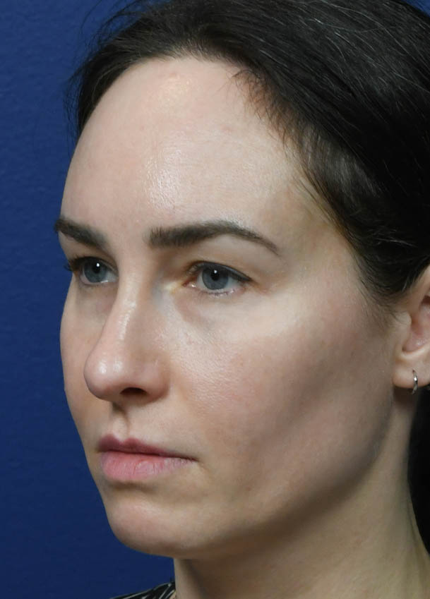 1_0022_Rhinoplasty 35 Left Oblique Preop.jpg