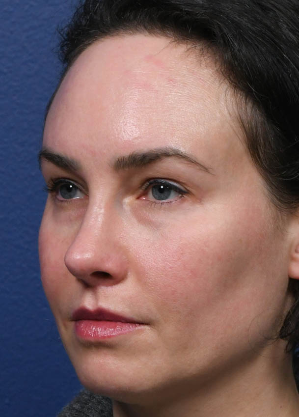 1_0023_Rhinoplasty 35 Left Oblique Postop 7 months.jpg