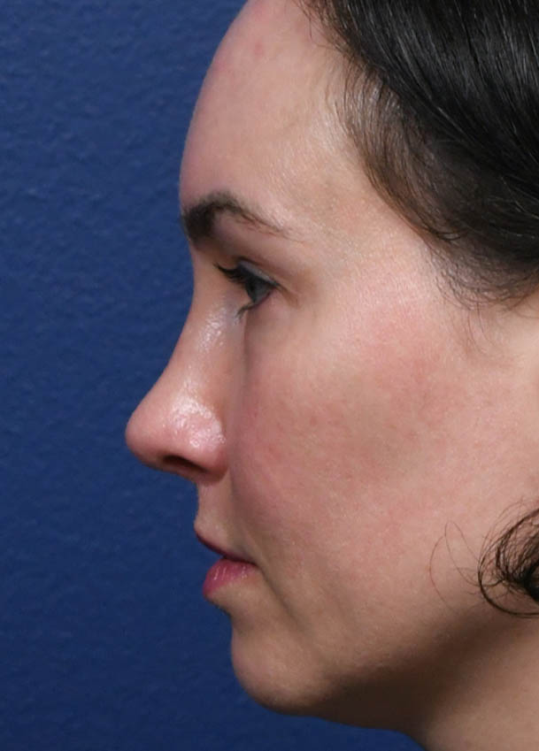 1_0025_Rhinoplasty 35 Left Proflie Postop 7 months.jpg