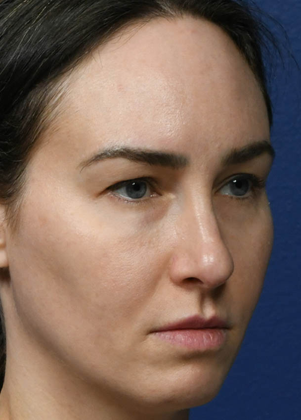 1_0026_Rhinoplasty 35 Right Oblique Preop.jpg