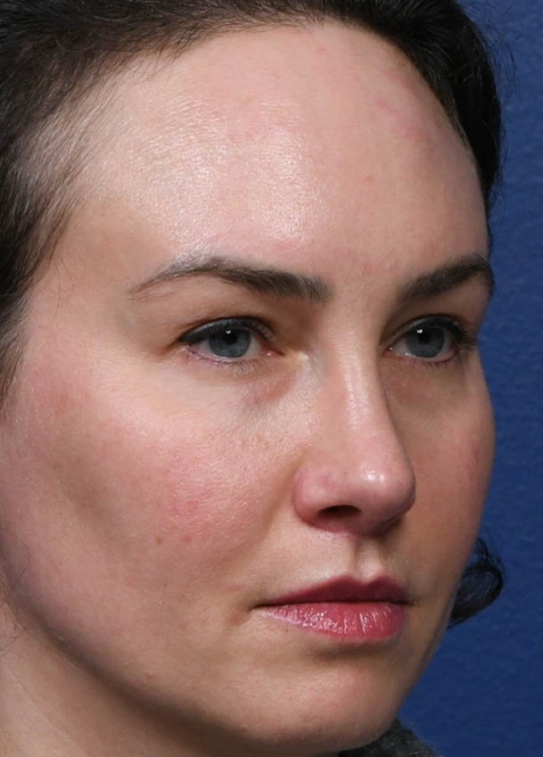 1_0027_Rhinoplasty 35 Right Oblique Postop 7 months.jpg