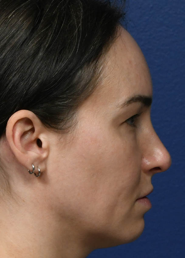 1_0028_Rhinoplasty 35 Right Profile Preop.jpg