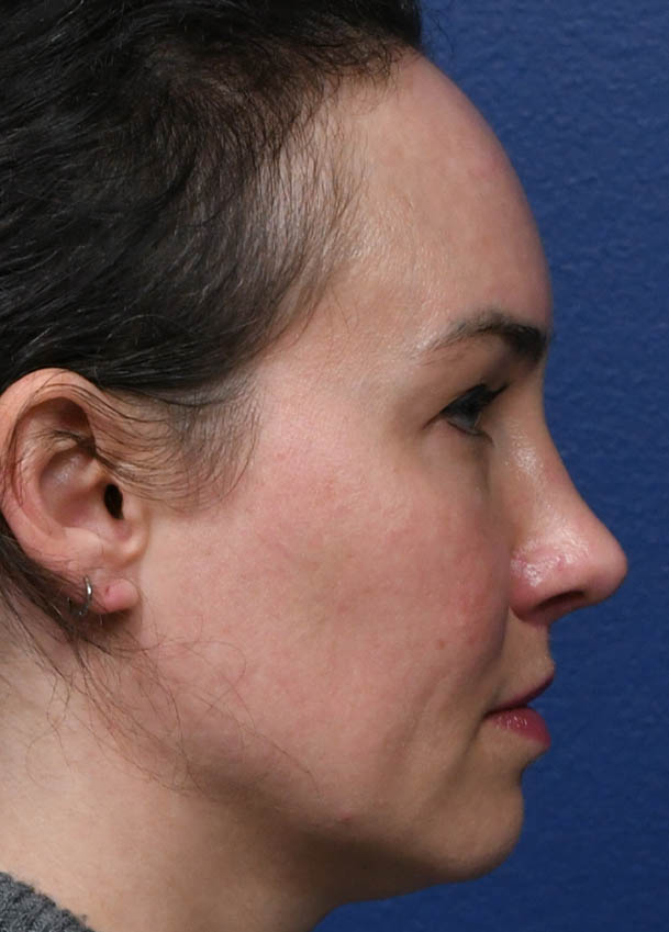 1_0029_Rhinoplasty 35 Right Profile Postop 7 months.jpg