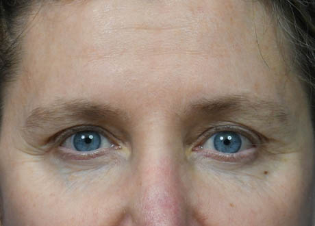 1_0000_Browlift 6 Postop.jpg