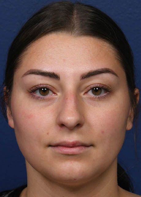 1_0000_NM Frontal Preop.jpg