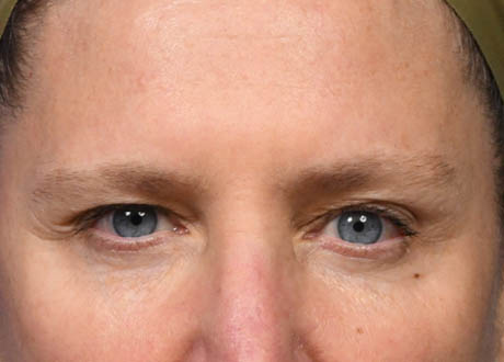 1_0001_Browlift 6 Preop.jpg