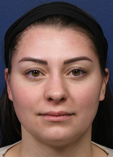 1_0001_NF Frontal Postop 5 months.jpg