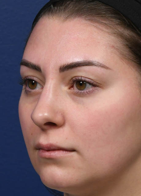 1_0003_NM Left Oblique Postop 5 months.jpg