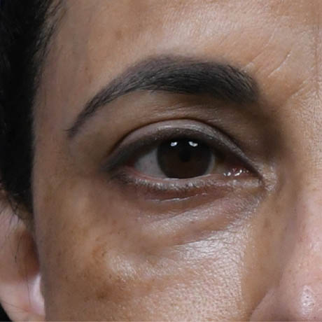 1_0004_Lower Bleparhoplasty 6 Preop.jpg