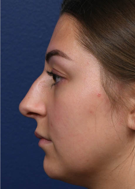 1_0004_NM Left Profile Preop.jpg