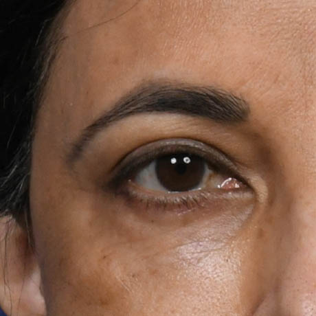 1_0005_Lower Blepharoplasty 6 12 month Postop.jpg