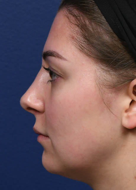 1_0005_NM Left Profile Postop 5 omnths.jpg