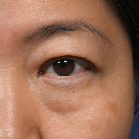 1_0006_Lower Blepharoplasty 7 Preop.jpg