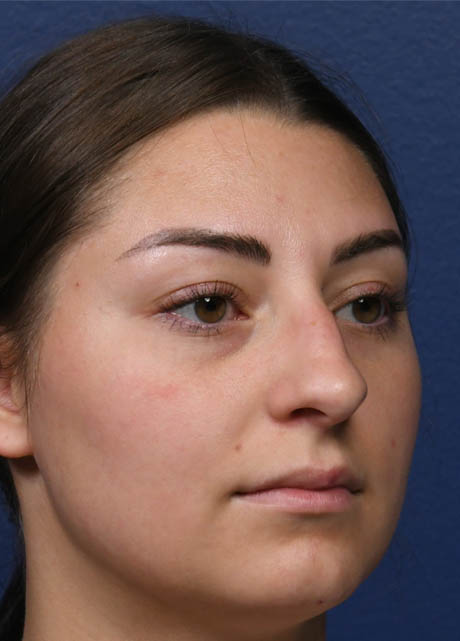 1_0006_NM Right Oblique Right Oblique Preop.jpg