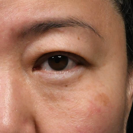 1_0007_Lower Blepharoplasty 7 Postop.jpg