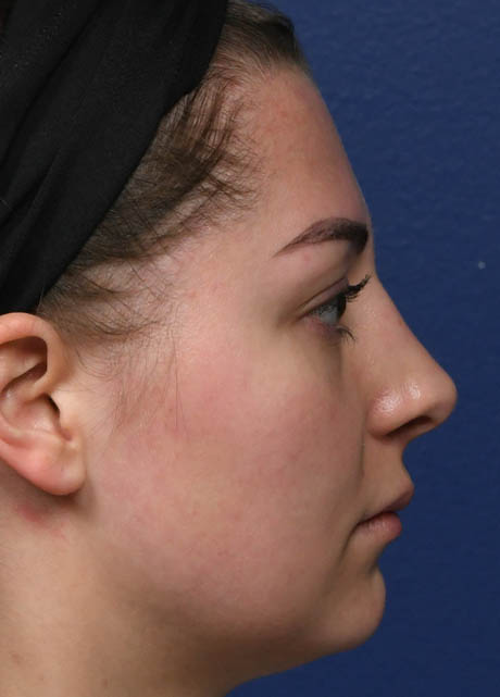 1_0009_NM Right Profile Postop 5 months.jpg