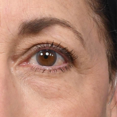 1_0010_Upper & Lower Blepharolasty 3 Preop.jpg