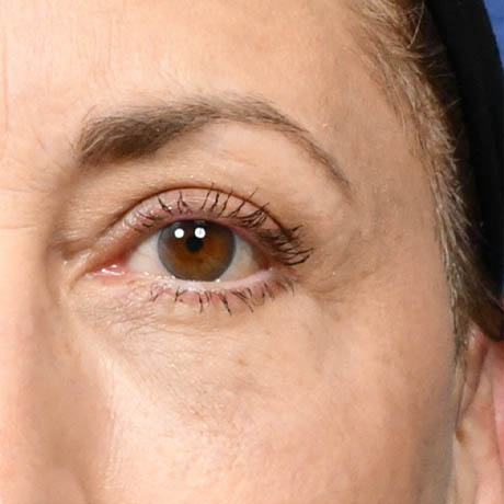 1_0011_Upper & Lower Blepharoplasty 3 Postop.jpg