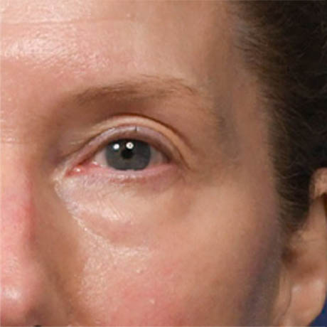 1_0012_Upper & Lower Blepharoplasty 4 Preop.jpg