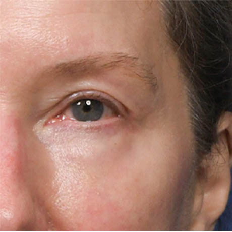 1_0013_Upper & Lower Blepharoplasty 4 Postop.jpg