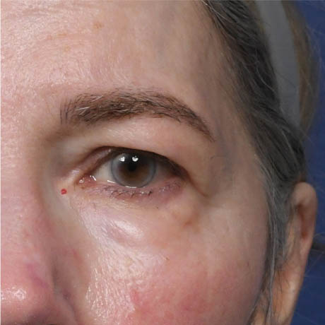 1_0014_Upper & Lower Blepharoplasty 5 Preop.jpg