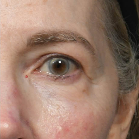 1_0015_Upper & Lower Blepharoplasty 5 Postop .jpg