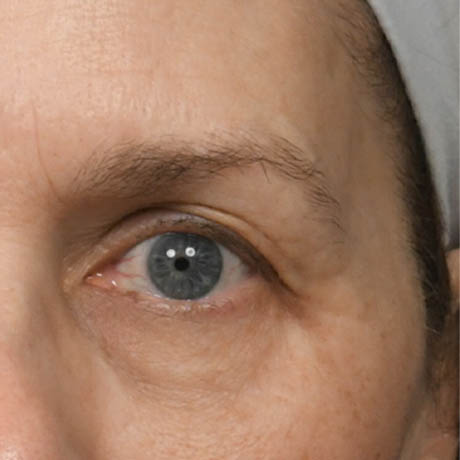 1_0016_Upper Blepharoplasty 13 Preop.jpg