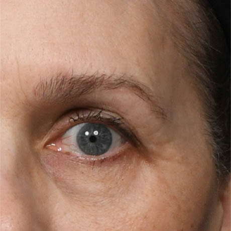 1_0017_Upper Blepharoplasty 13 Postop.jpg