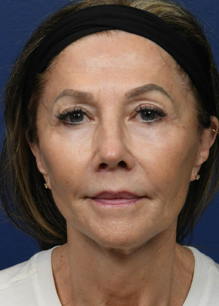 1_0000_CO2 Laser Resurfacing 1- VM Frontal Postop.jpg
