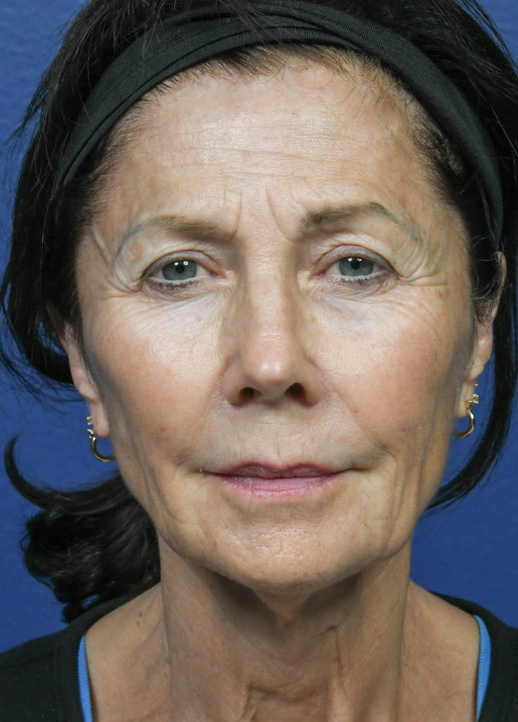 1_0001_CO2 Laser Resurfacing 1- VM Frontal Preop.jpg