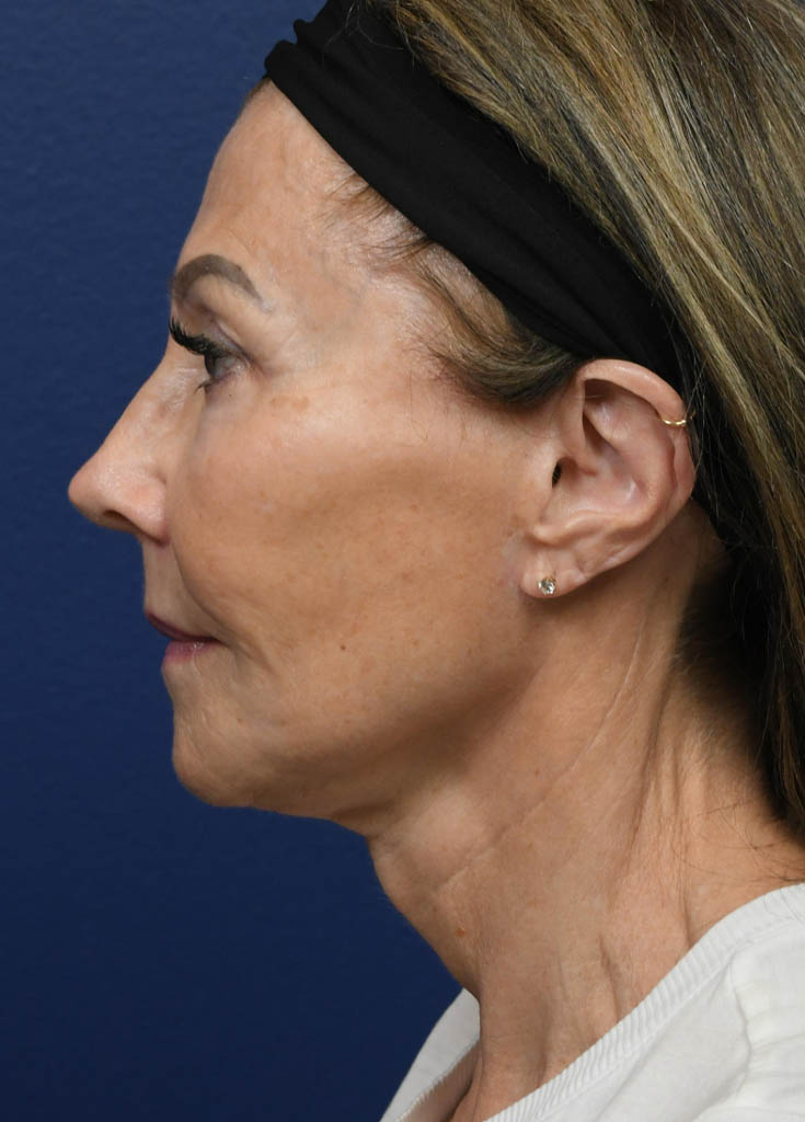 1_0004_CO2 Laser Resurfacing 1- VM Left Profile Postop.jpg