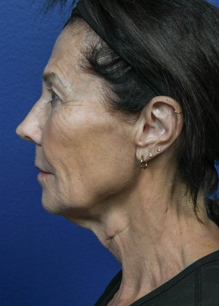 1_0005_CO2 Laser Resurfacing 1- VM Left Profile Preop.jpg