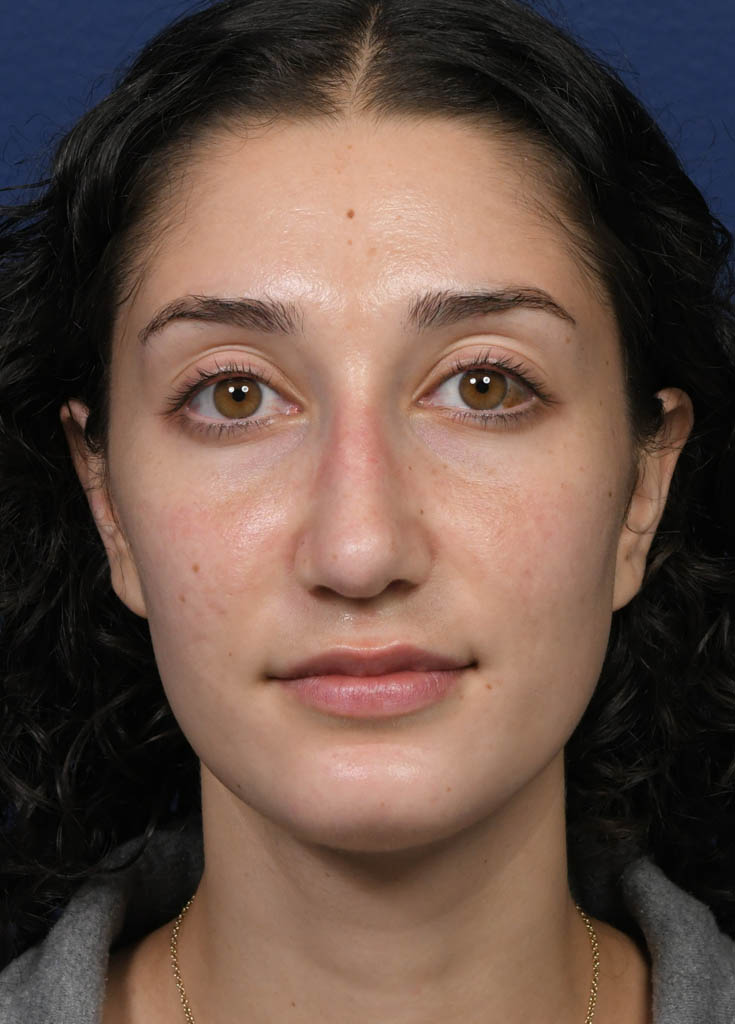 1_0006_MF Frontal Post Profractional.JPG