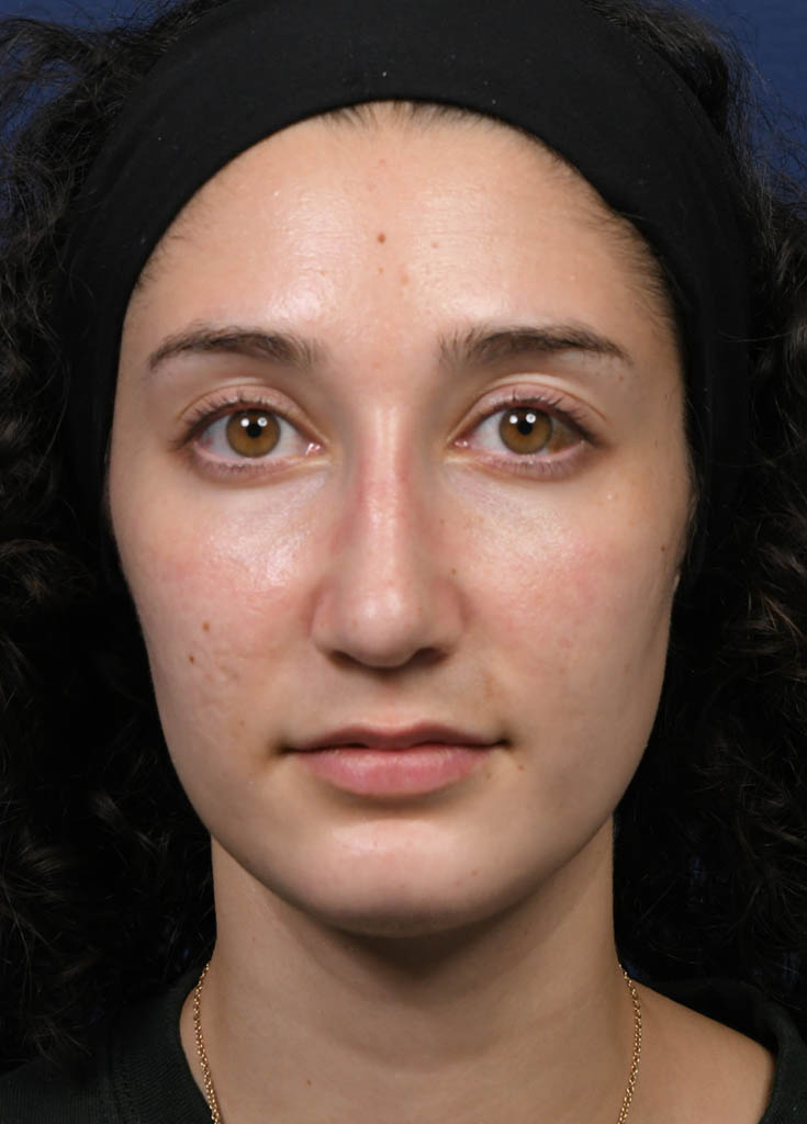 1_0007_MF Frontal Pre Profractional.JPG