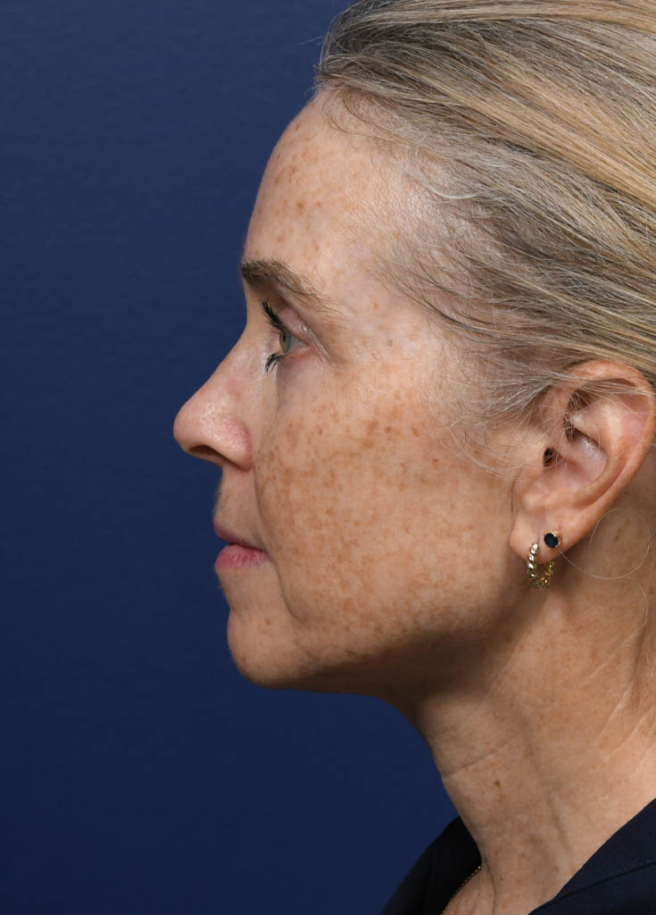 1_0008_KK Profile Pre Op.JPG