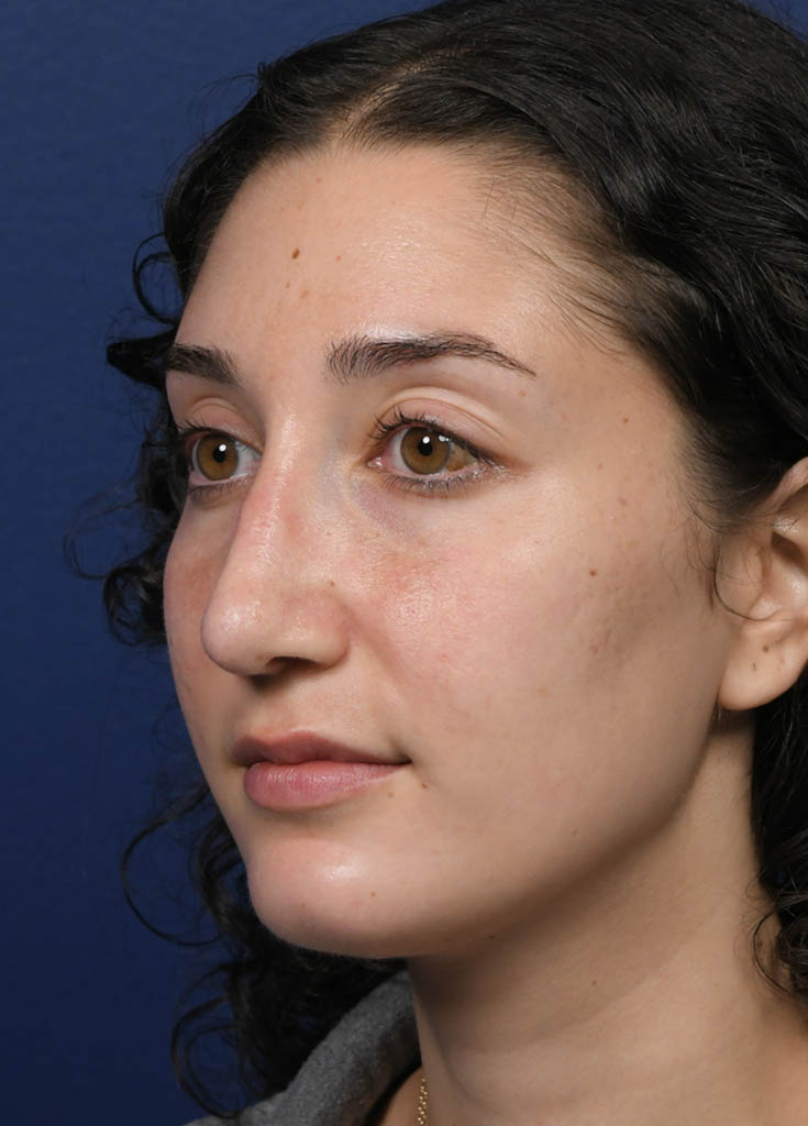 1_0008_MF Oblique Left Post Profractional.JPG