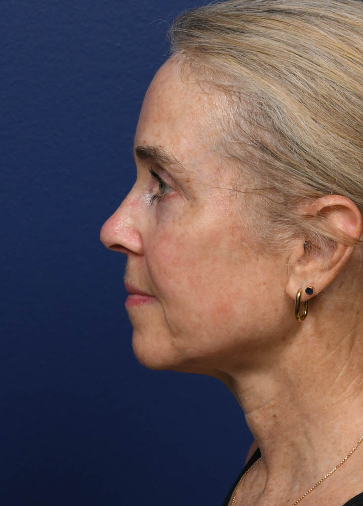 1_0009_KK Profile Post Op.JPG