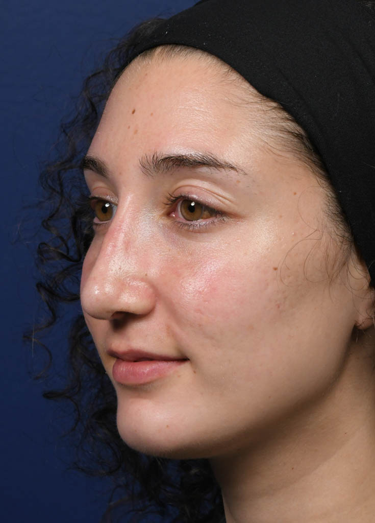 1_0009_MF Oblique Left Pre Profractional.JPG