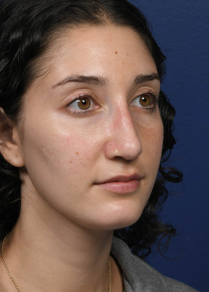 1_0010_MF Oblique Right Post Profractional.JPG