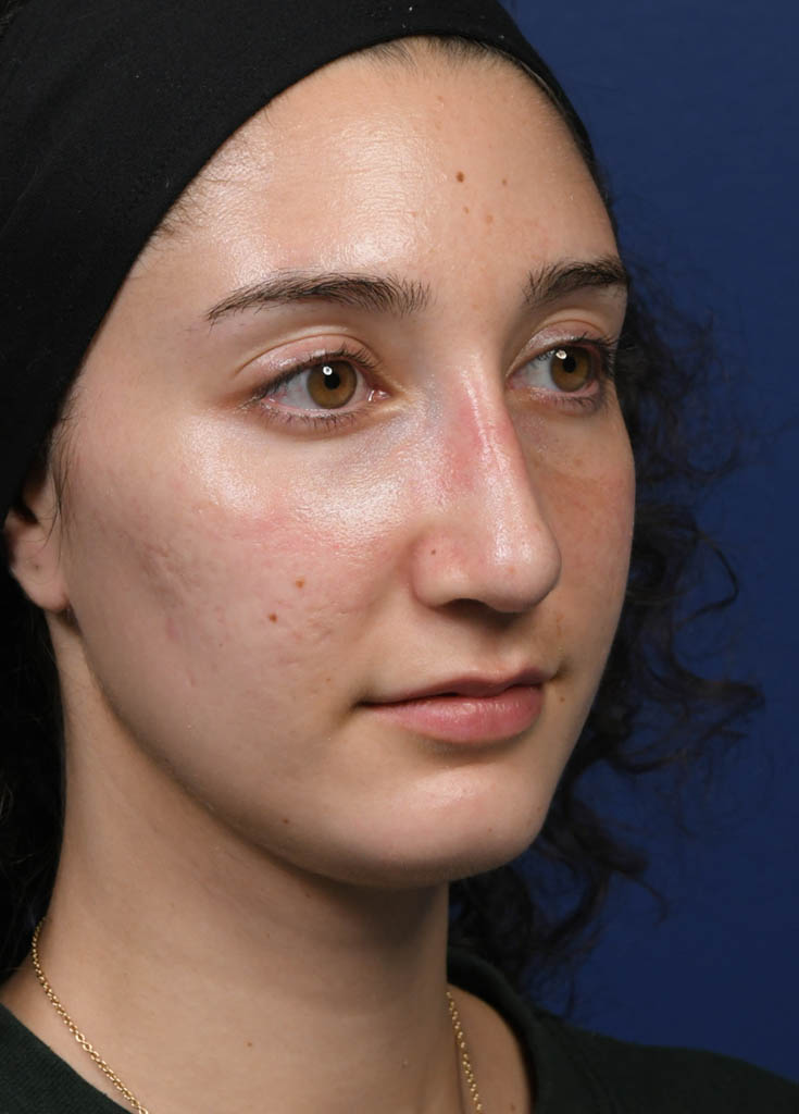 1_0011_MF Oblique Right Pre Profractional.JPG