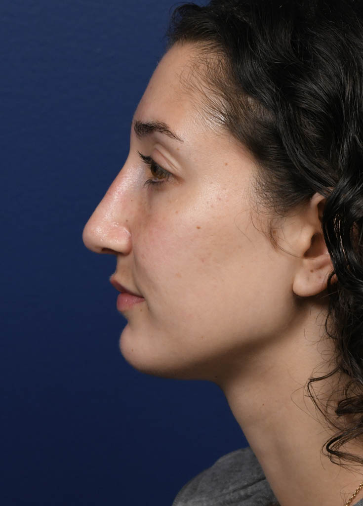 1_0012_MF Profile Left Post Profractional.JPG