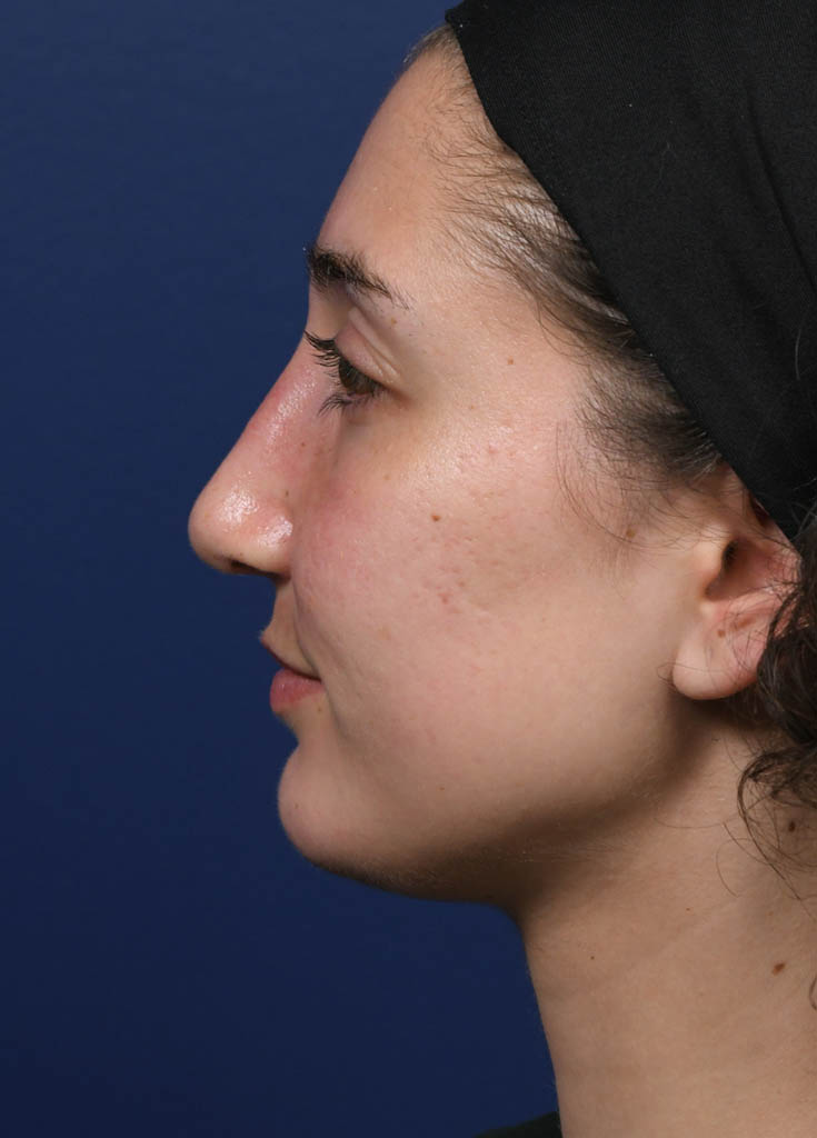 1_0013_MF Profile Left Pre Profractional.JPG