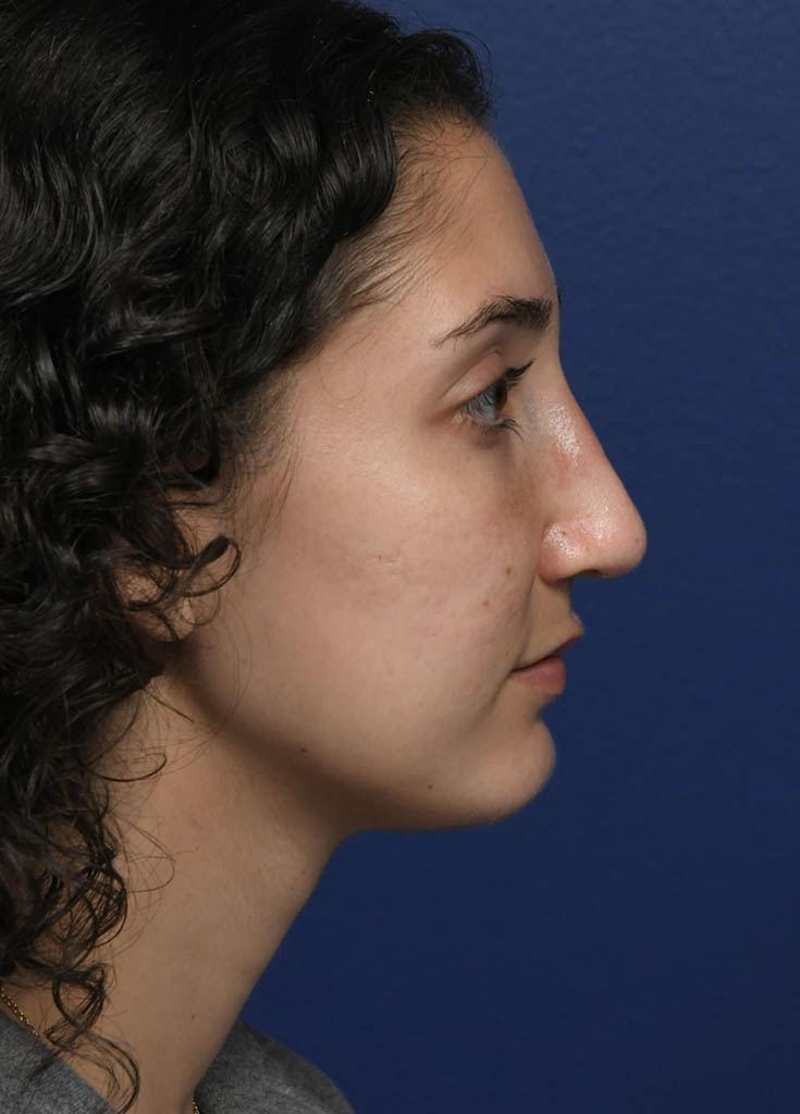 1_0014_MF Profile Right Post Profractional.JPG