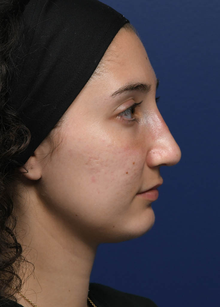 1_0015_MF Profile Right Pre Profractional.JPG