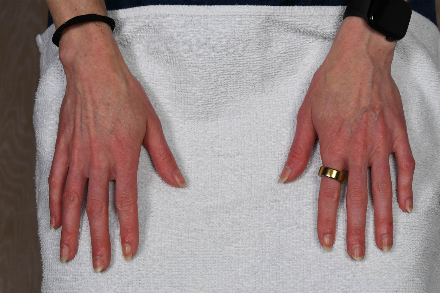 1_0016_AD Hands Post op.JPG