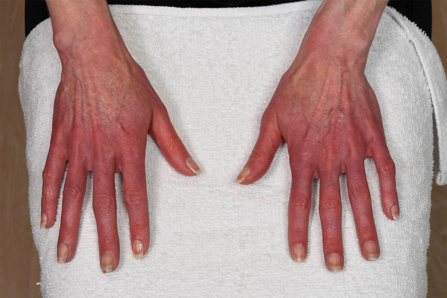 1_0017_AD Hands Pre Op.JPG