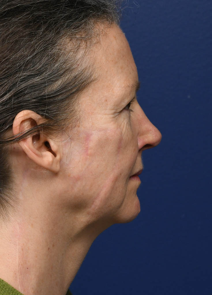 1_0018_SJ Profile 2 Post Profractional.JPG
